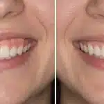 gummy smile mersin ortodonti Mersin Gummy smile